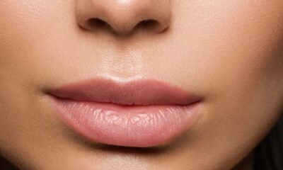 augmentare buze cu laser